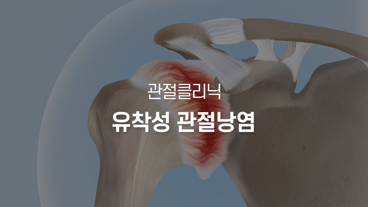 유착성 관절낭염
