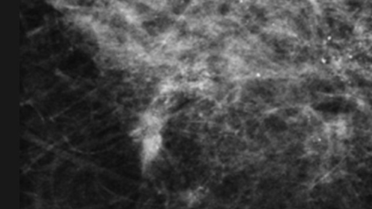 유방 미세석회화