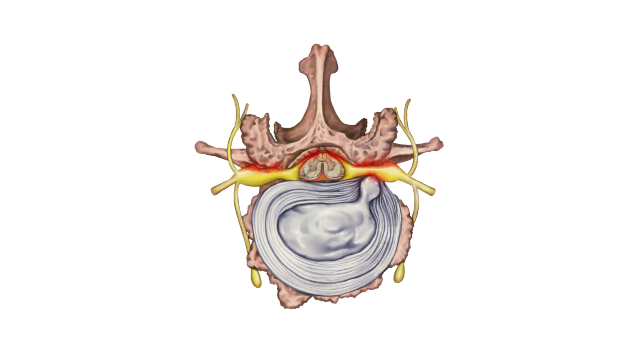 허리통증 유발하는 척추관협착증 질환 파헤쳐보자~!